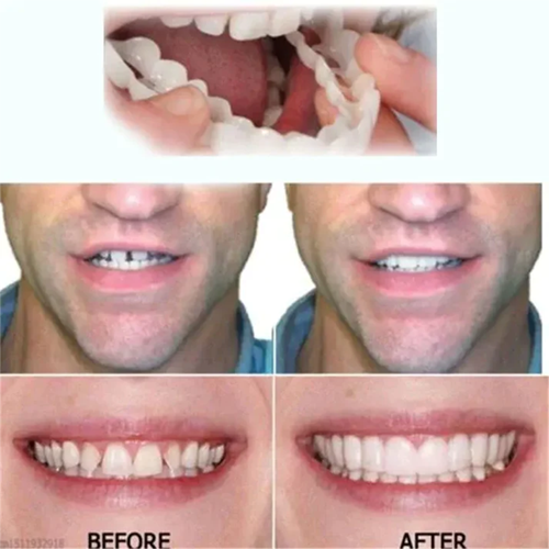 Adjustable Snap-On Dentures