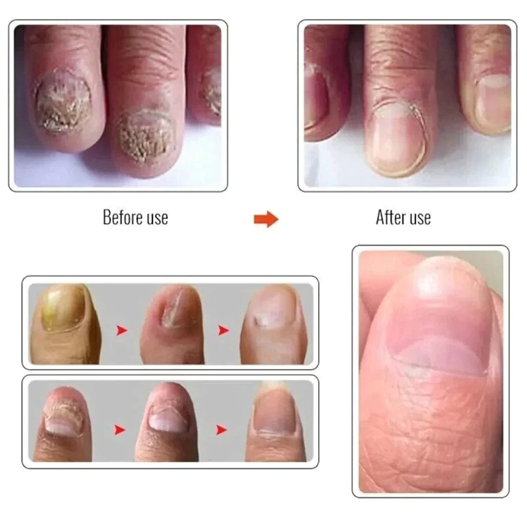 NAILS SERUM FOR NAIL GROWTH & REPAIR, FUNGAL INFECTION, ANTI-INFECTIVE REMOVAL PARONYCHIA ONYCHOMYCOSIS