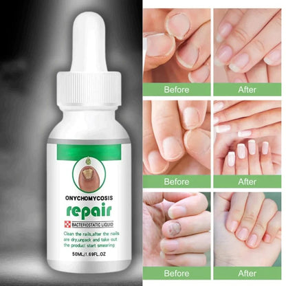 NAILS SERUM FOR NAIL GROWTH & REPAIR, FUNGAL INFECTION, ANTI-INFECTIVE REMOVAL PARONYCHIA ONYCHOMYCOSIS